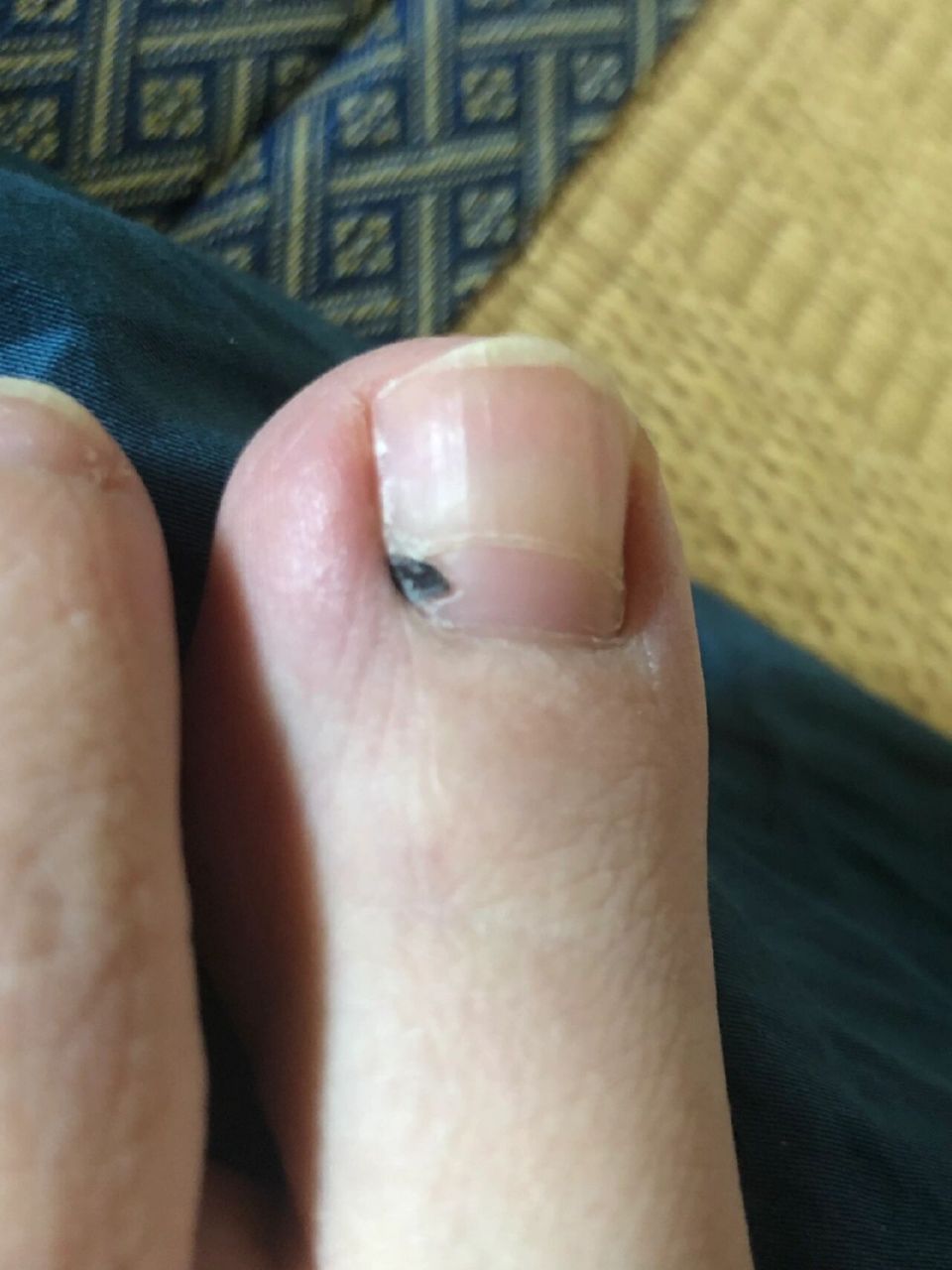 脚趾发黑 生完娃1个月的时候,大脚趾一直微微痛,以为是生完之后缺钙