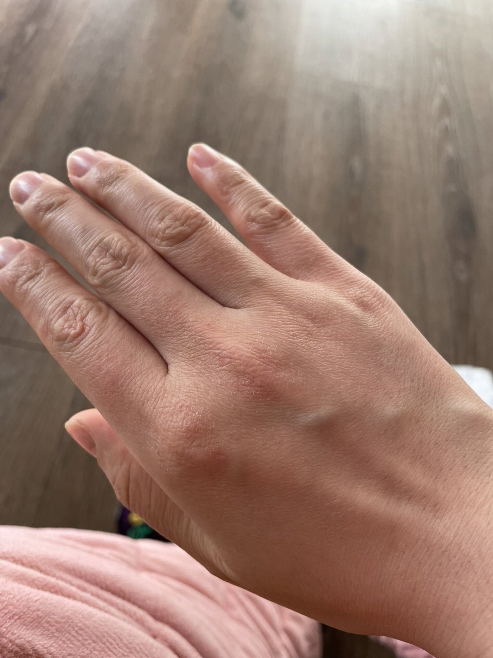 阳了手部干燥缺水 我这是得了脱水株吗,手变得跟树皮一样粗糙