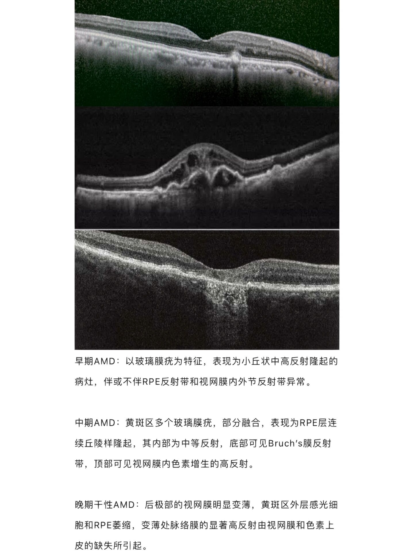 黄斑病变的oct图解合集(一) oct 图解 | 黄斑病变的oct图解合集 黄斑