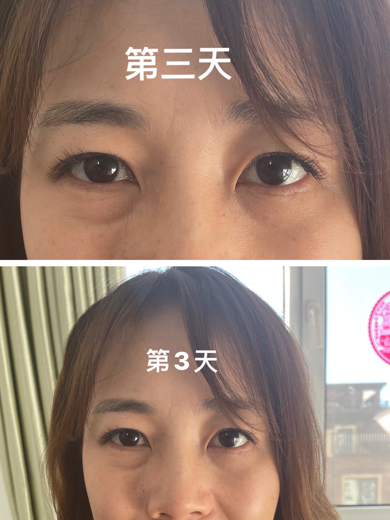 除皱针肉毒注射49天 前后对比图