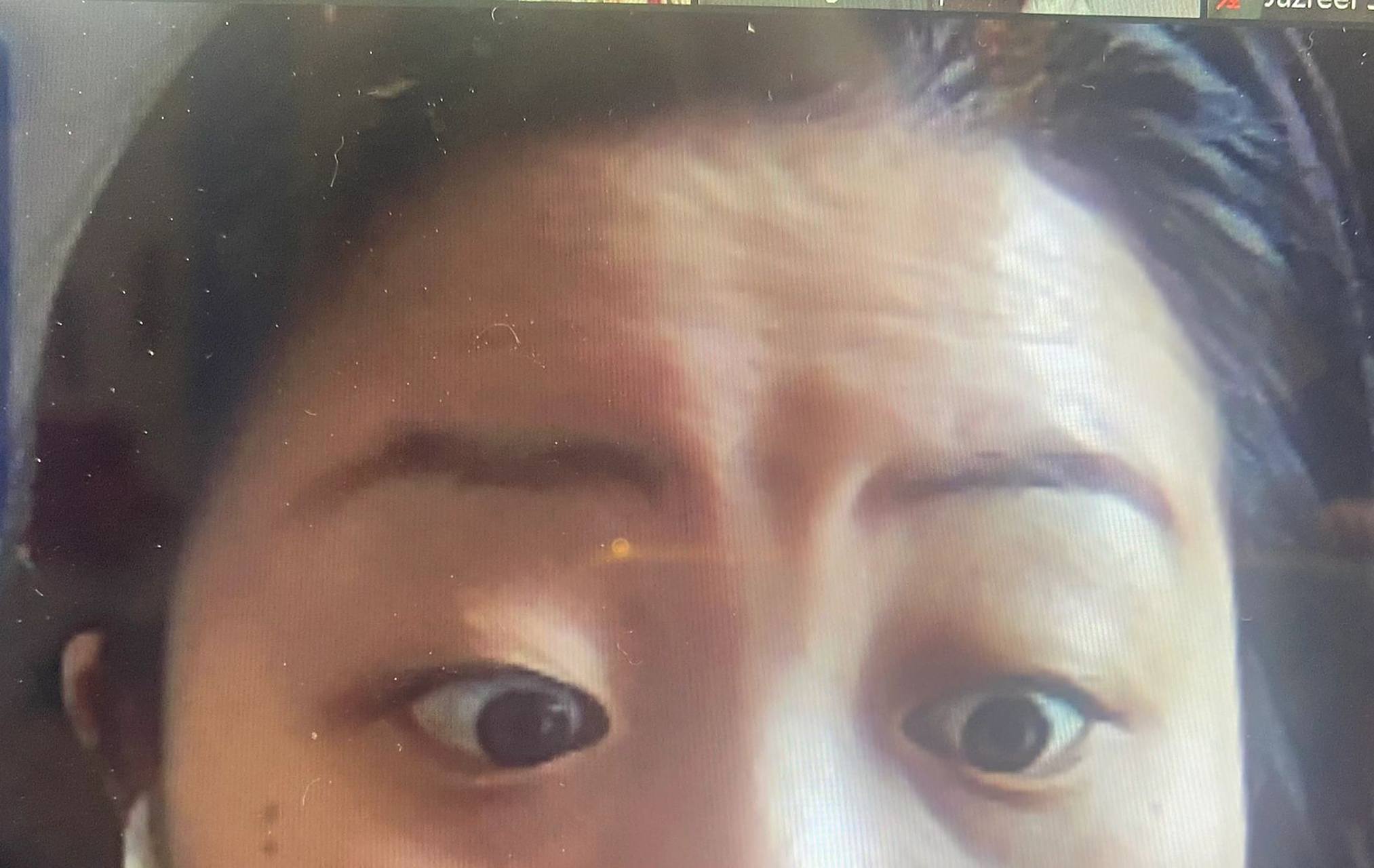 有没有姐妹和我一样,眉心凹陷?好丑哦, 该怎么改善?