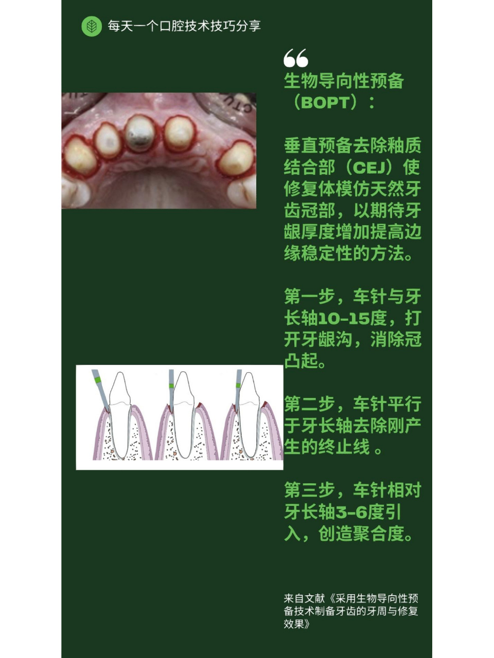 71每天一个口腔技术技巧分享【bopt】 生物导向性预备(bopt): 垂直