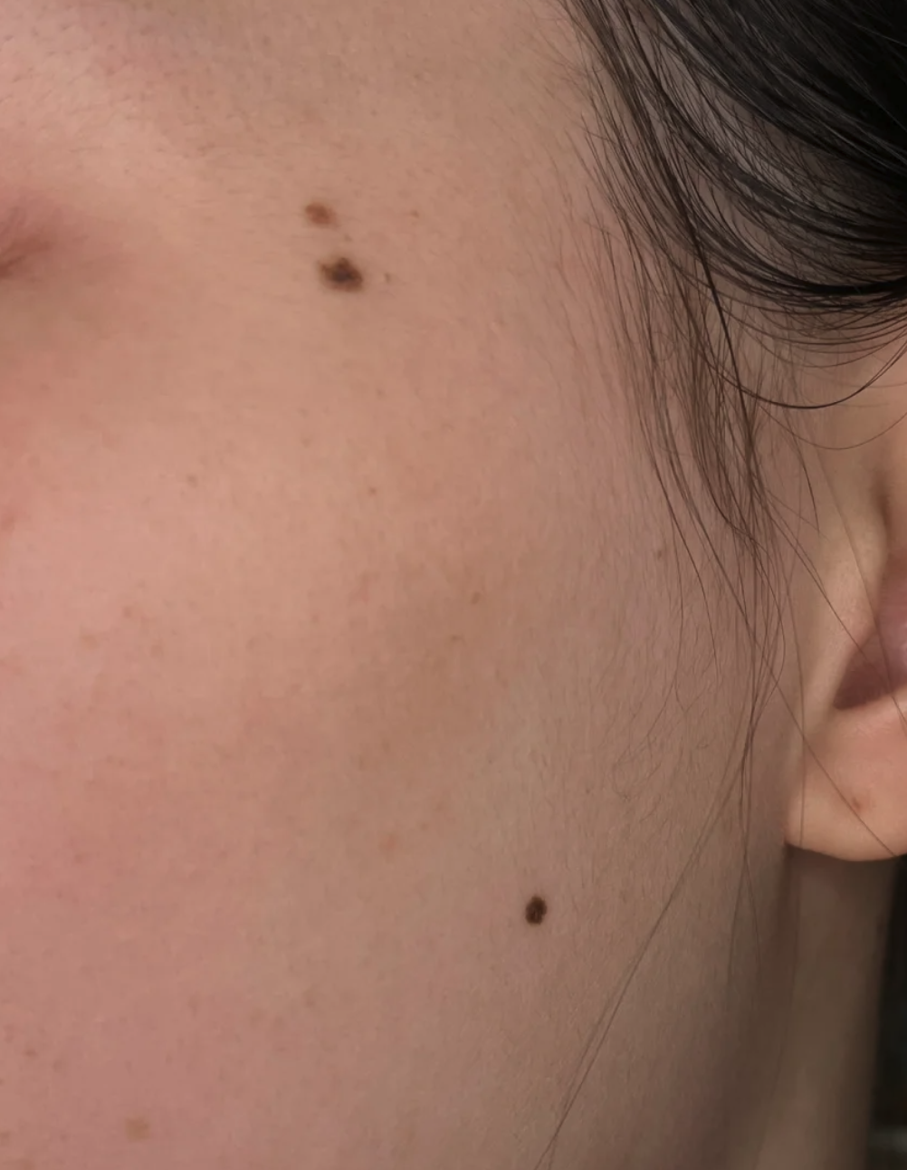 脸上长黑痣主要有三个常见原因:先天发育,内分泌紊乱和日光照射