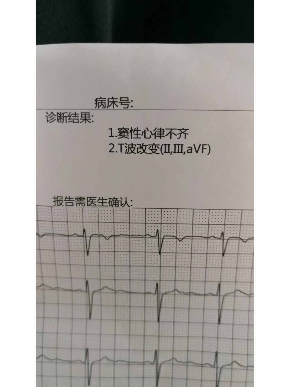 t波低平心电图图片