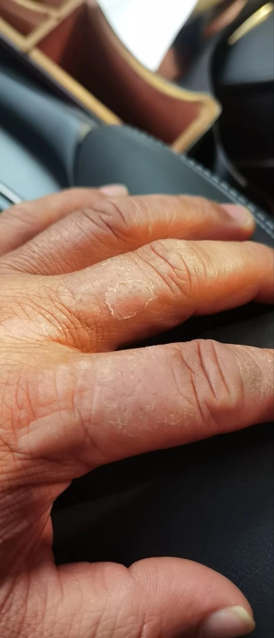 手背干燥脱屑肥厚.特应性皮炎症状.#特应性皮炎