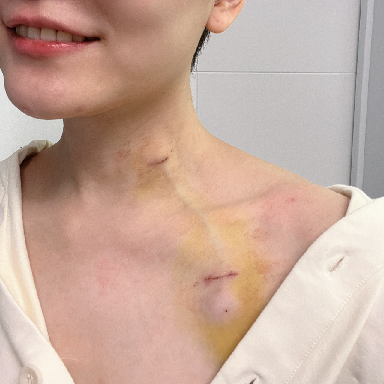 输液港终于不那么疼了 安港术后的第四天,终于没那么疼了,明天就要