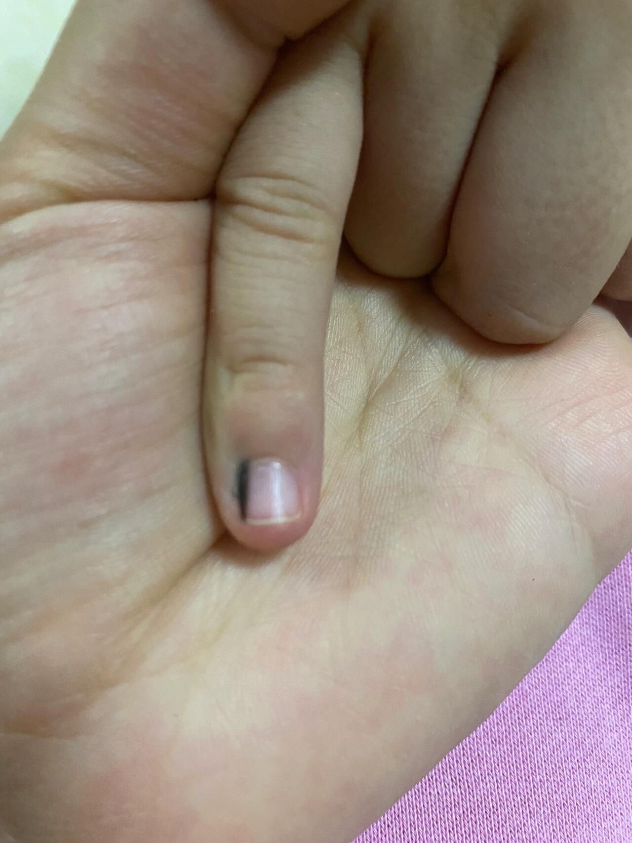 甲母痣 发现甲母痣3个月,之前一直以为是撞了导致的淤青.
