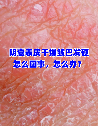 阴囊表皮干燥皱巴发硬可能由以下原因引起: