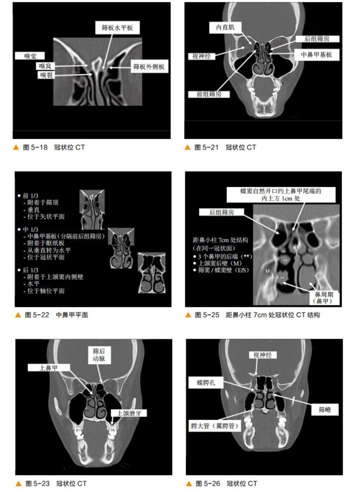 环状软骨ct解剖图图片