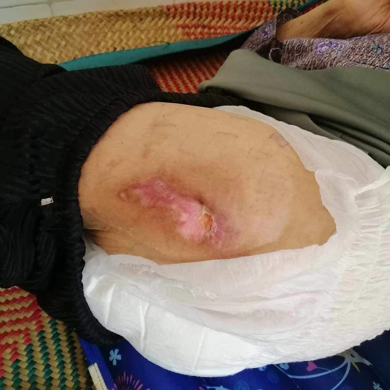 压疮,又叫褥疮,是长期卧床或坐位身上一种常见的皮肤损伤. .