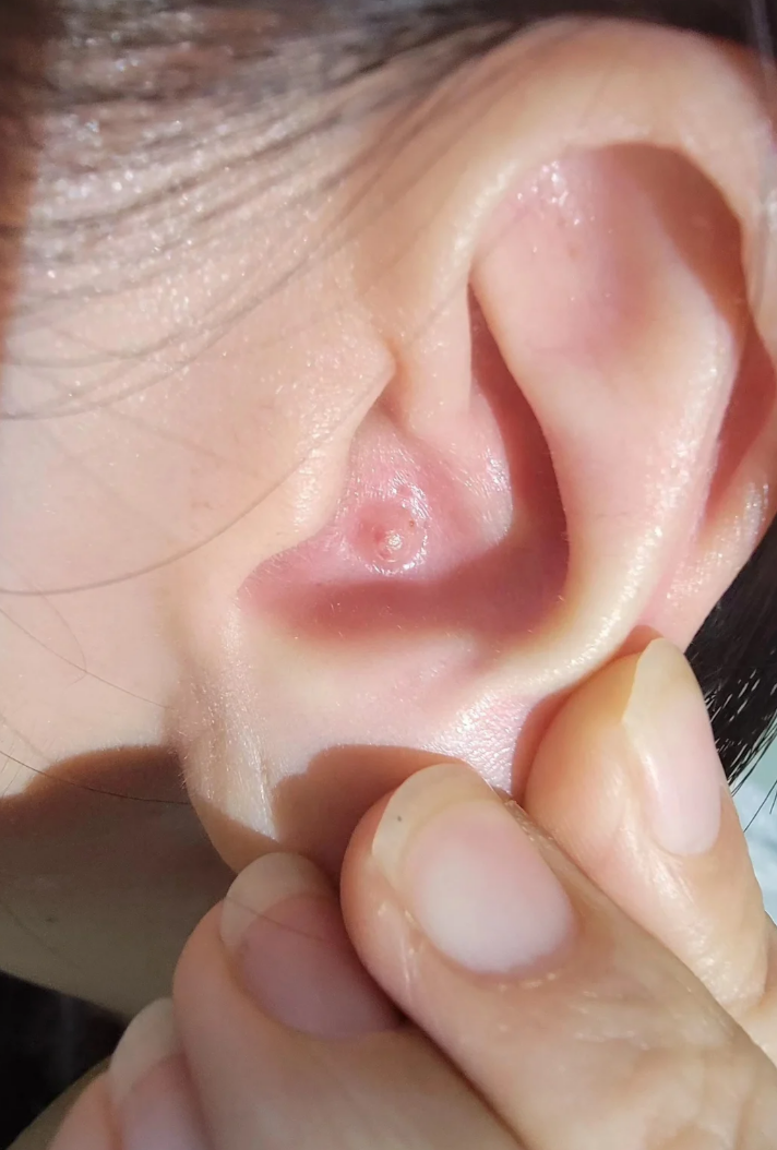 耳朵里长了个包一按就疼,这种情况常见的原因有以下几种: