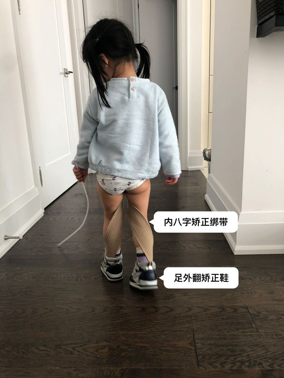 女兒的o型腿,走路內八字,足外翻矯正之路(2) 接上篇,佩戴內八字矯正