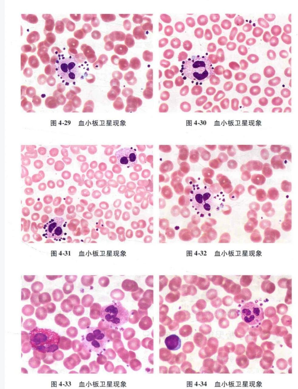 0615血小板卫星现象 99血小板卫星现象是血小板粘附,围绕于中性