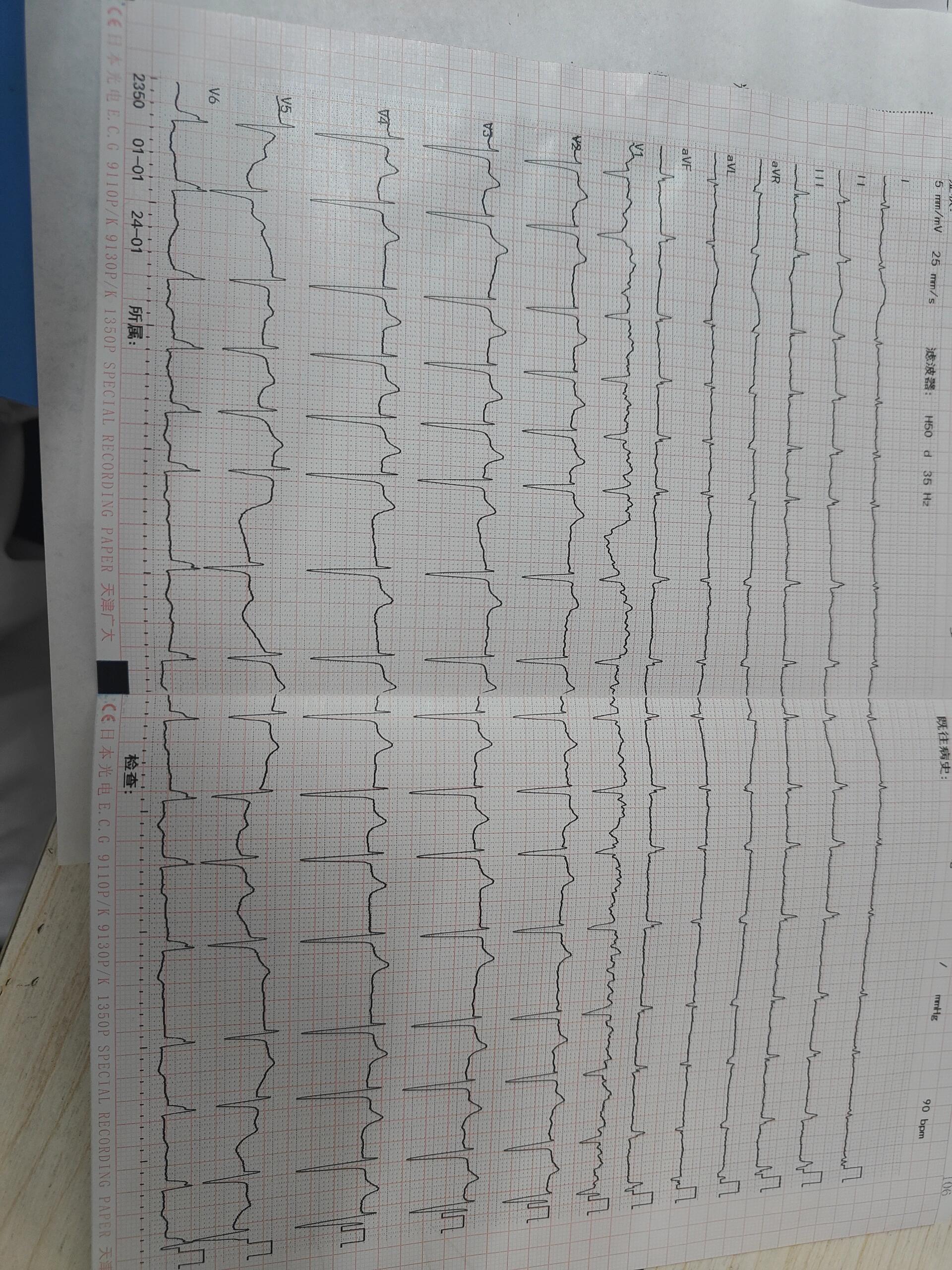 房颤心电图 正常图片