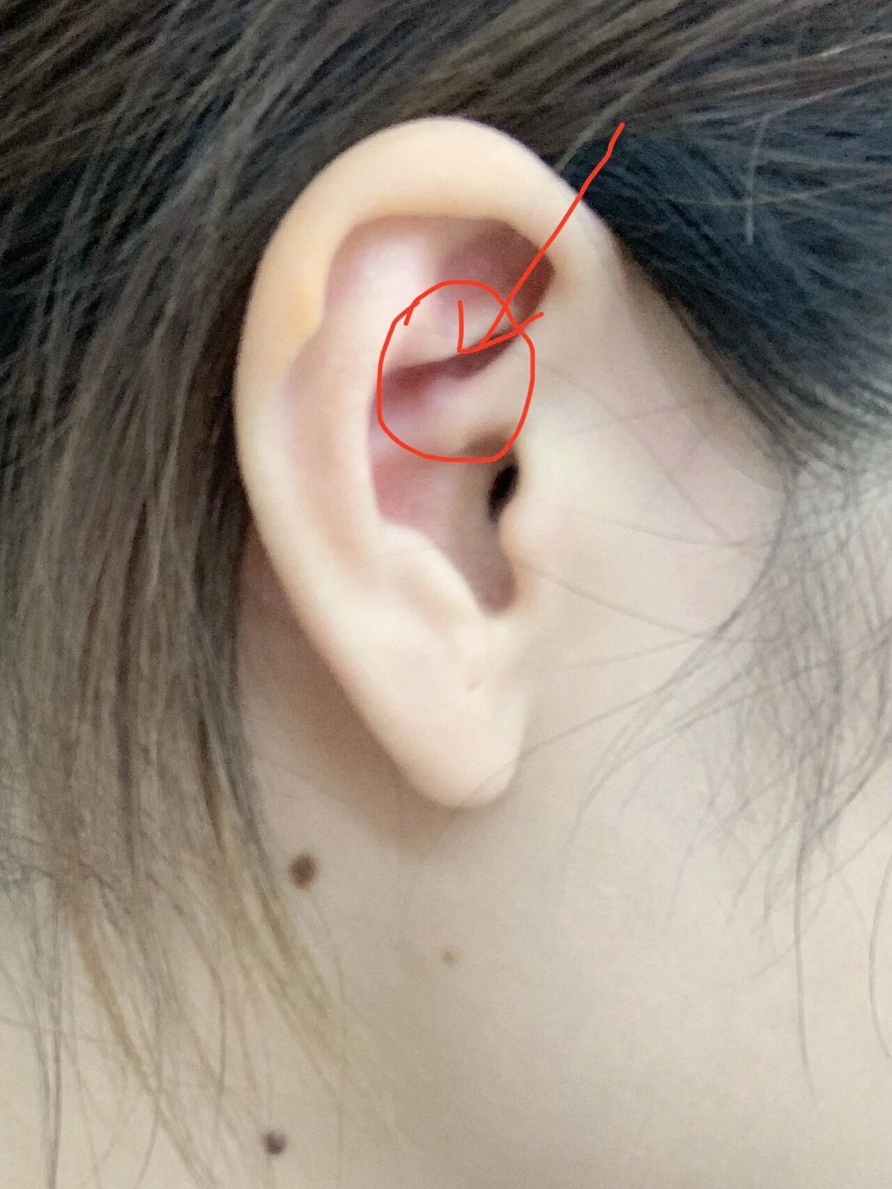 求职贴:耳廓上长了一个小硬包需要去医院嘛?