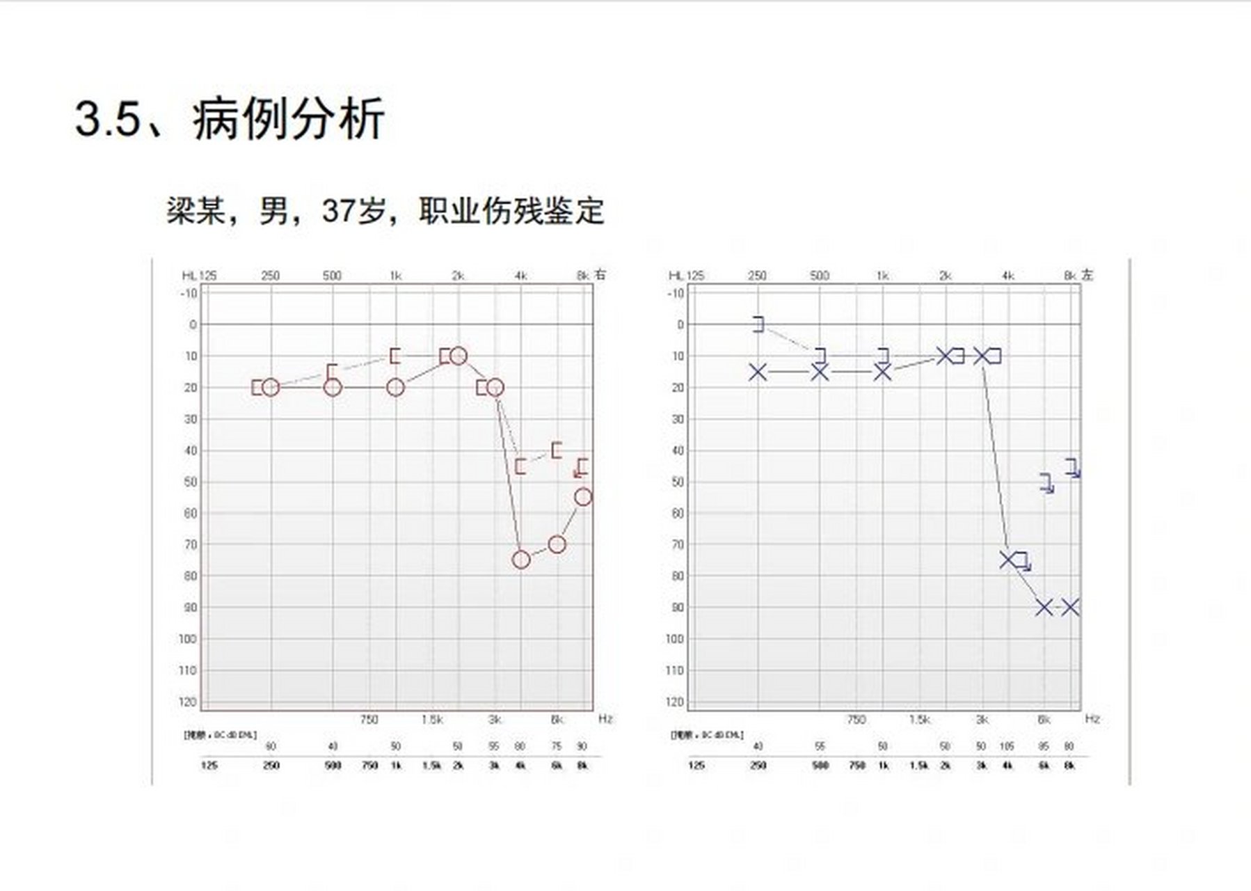 如何看懂听力检查报告(三)耳声发射 耳声发射检查临床应用于评估耳蜗