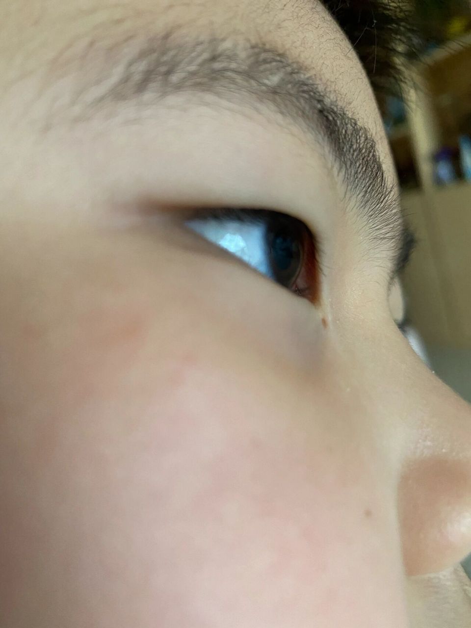 眼角这里小时候就有一个洞,有知道什么情况吗