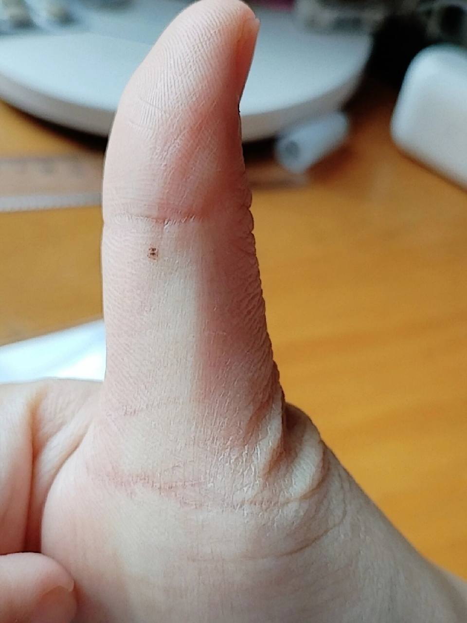 大拇指上最近莫名张了个痣,会不会癌变啊[ 大拇指上最近莫名张了个痣