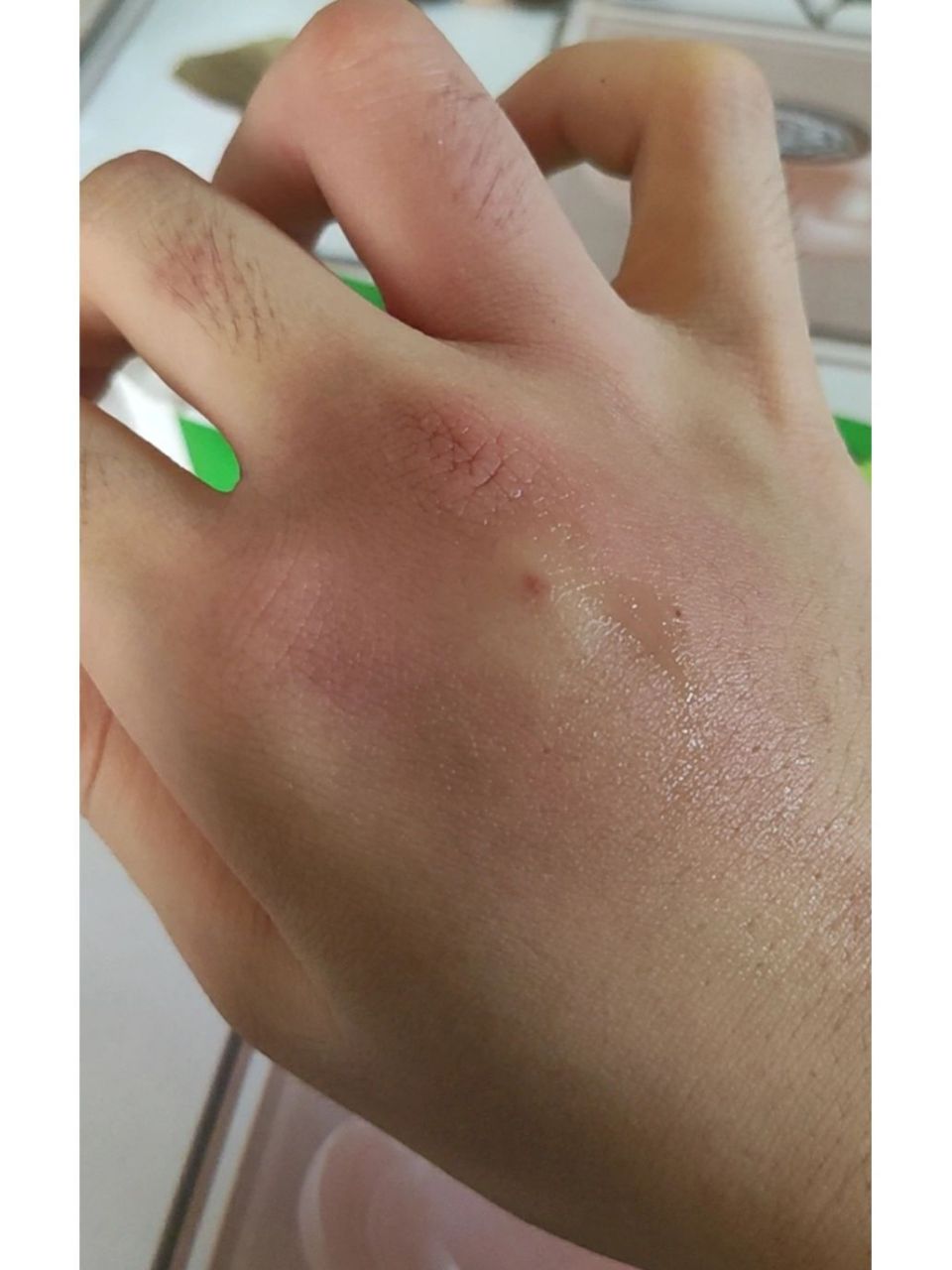 红蚂蚁92   被红蚂蚁咬了,没几秒钟就肿成猪蹄了 听说红蚂蚁是外来