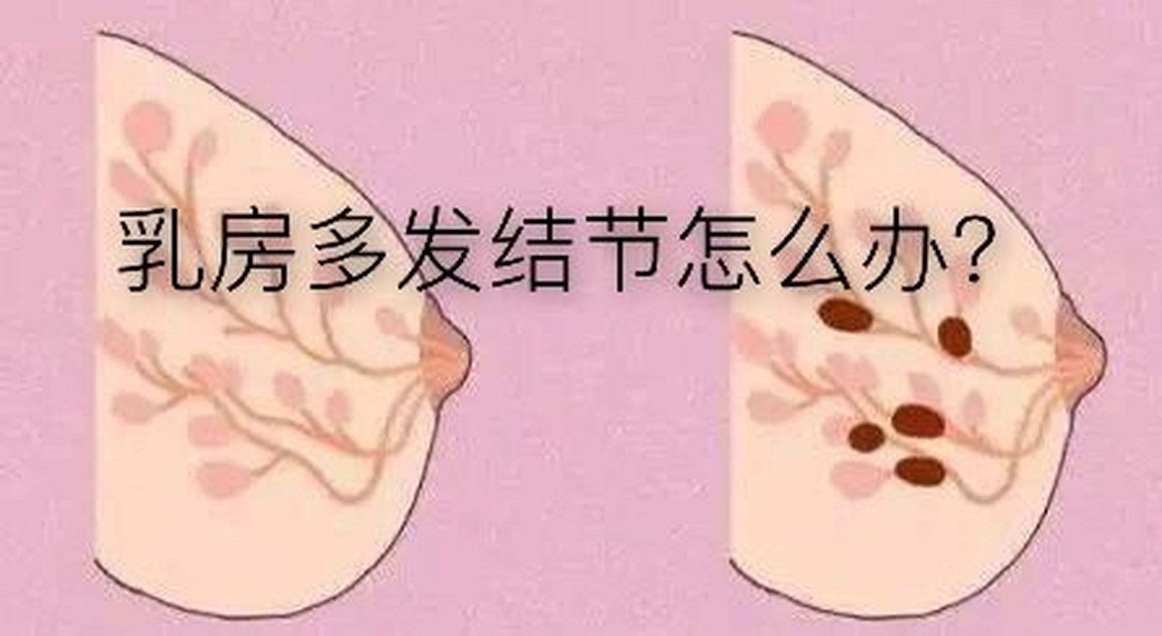 首先,乳房结节"和"乳房肿块"是指同一个疾病的不同阶段.