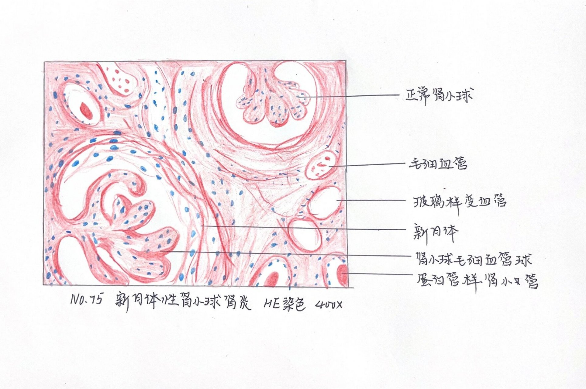 病理学红蓝铅笔绘图—新月体性肾小球肾炎 #医学生# #病理学实验红蓝