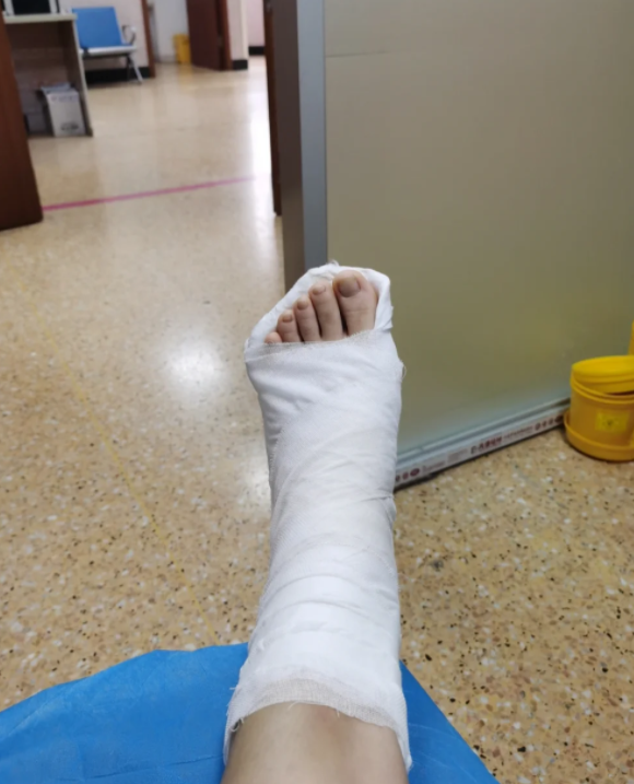 脚踝骨折想要好得快,关键要看骨折类型和治疗方法