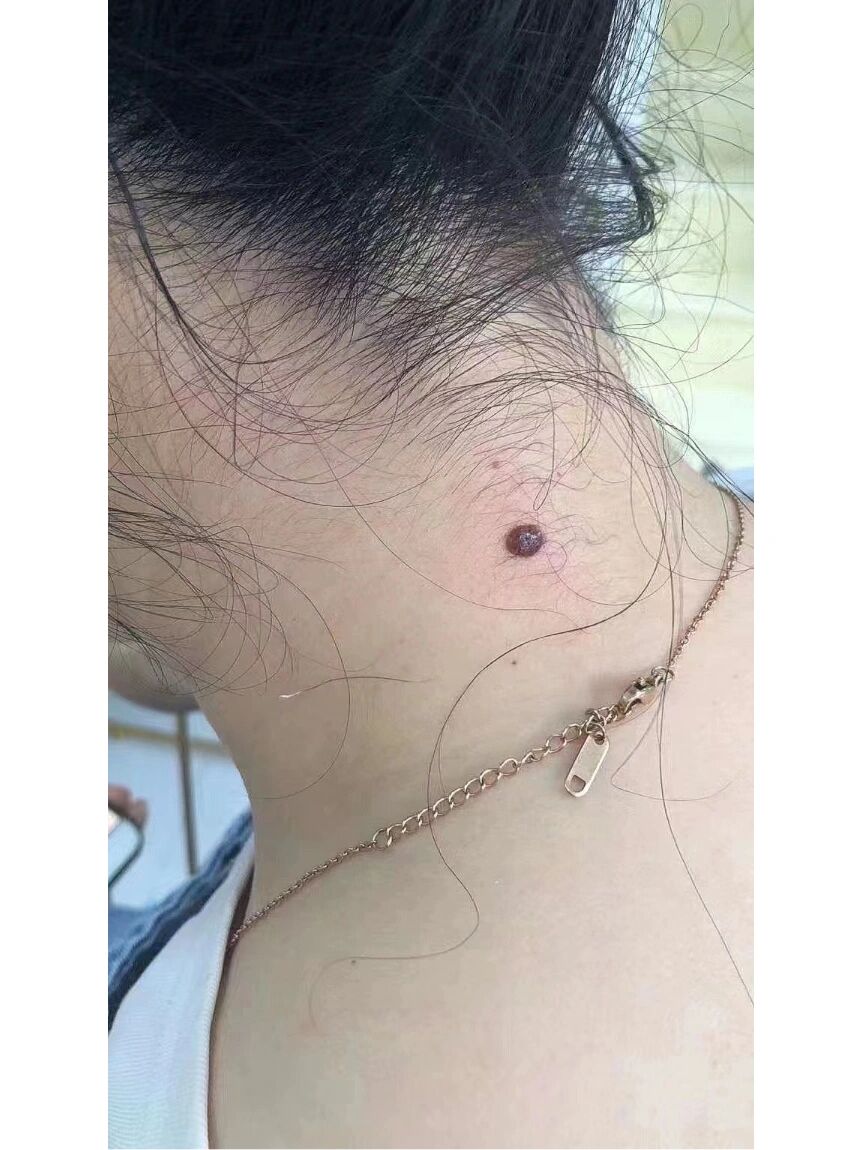 脖子大肉痣