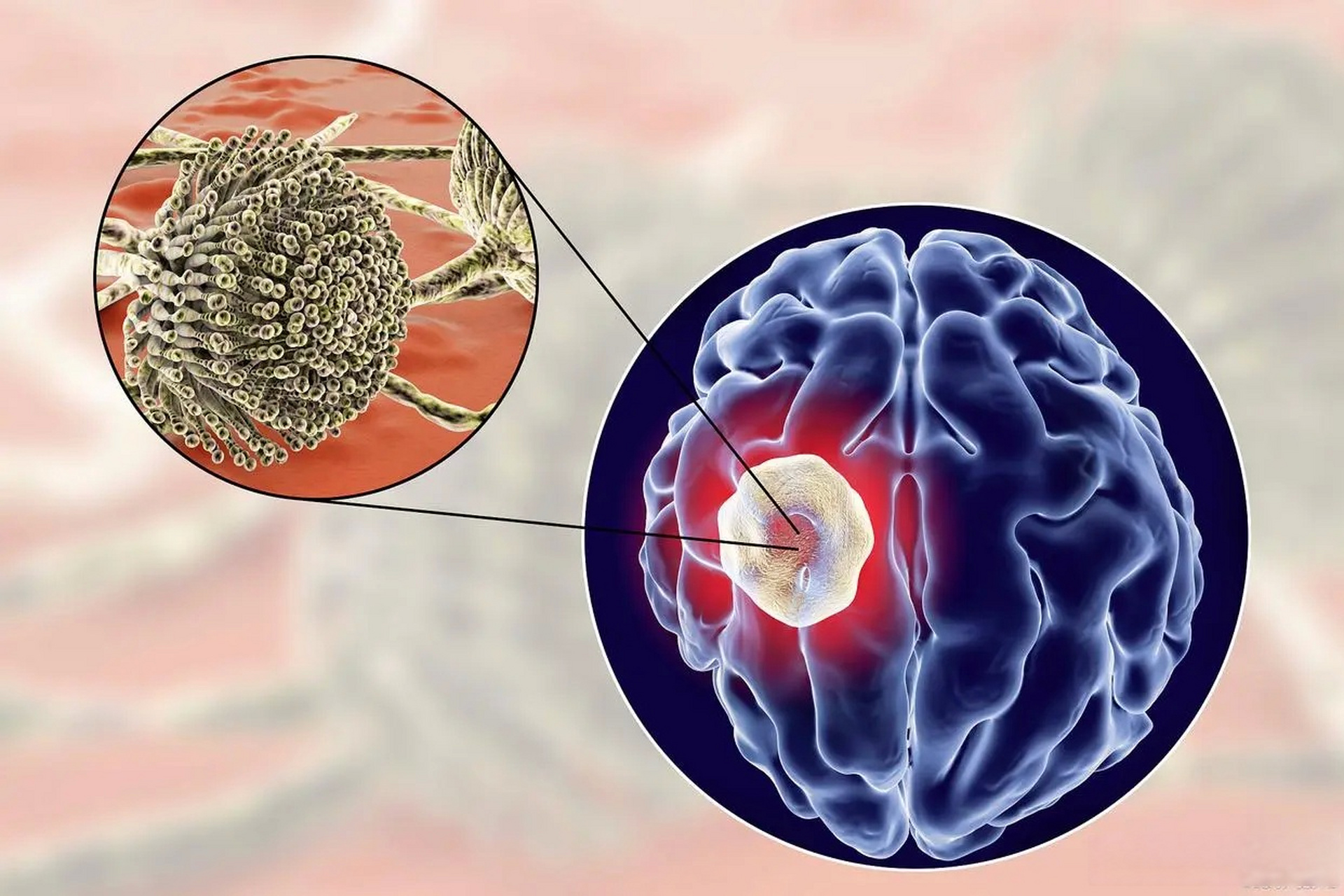 近日,一则关于贵州一名6岁孩子小丁(化名)感染食脑虫并引发脑膜炎的