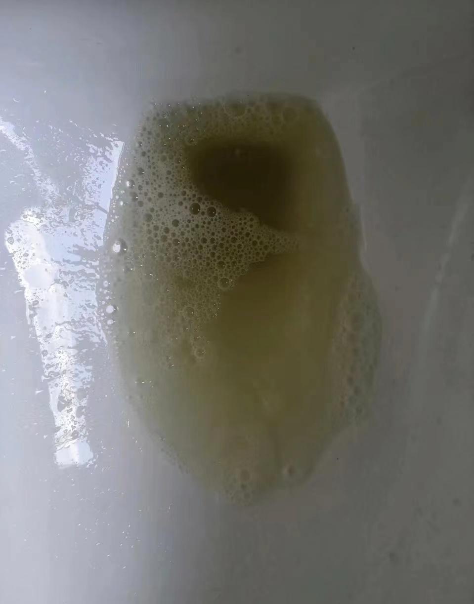 蛋白尿不能放任不管!