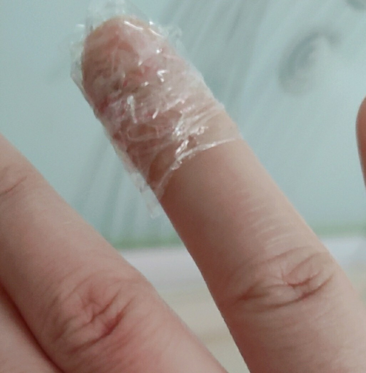 手指甲沟炎 右手无名指指甲边缘红肿跳疼发热好几天了,太痛苦了.