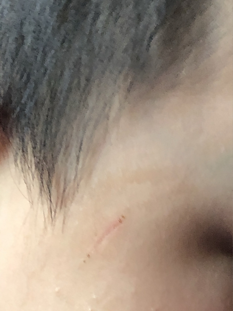 被邻居小孩指甲抓破了,今天一周了,结痂脱落后凹陷了,这种会留疤痕