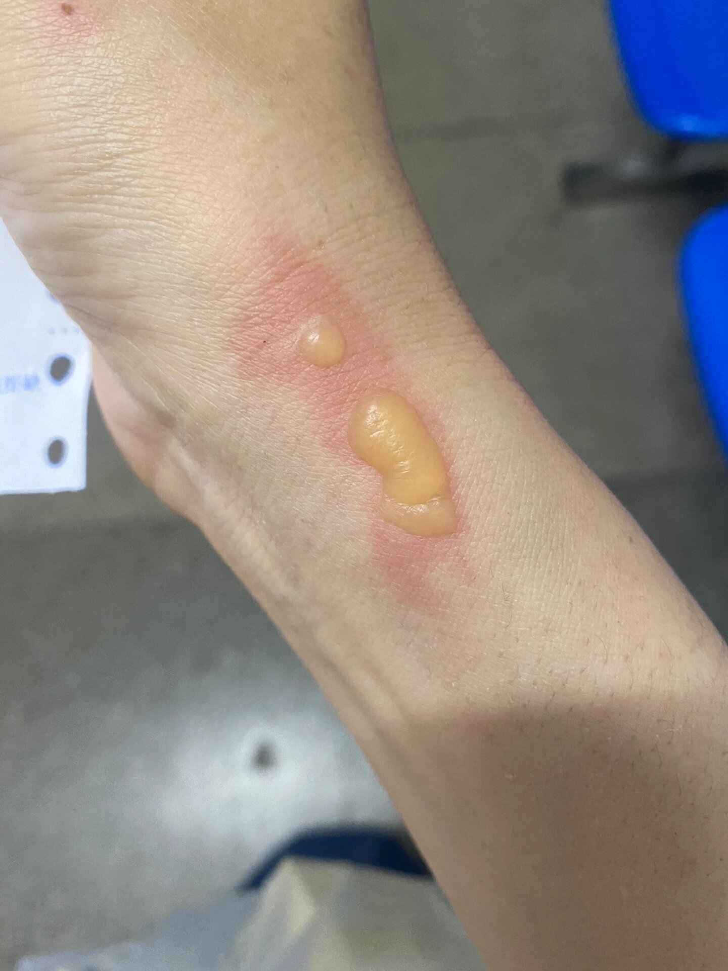 暖宝宝烫伤了,水泡要挑开吗