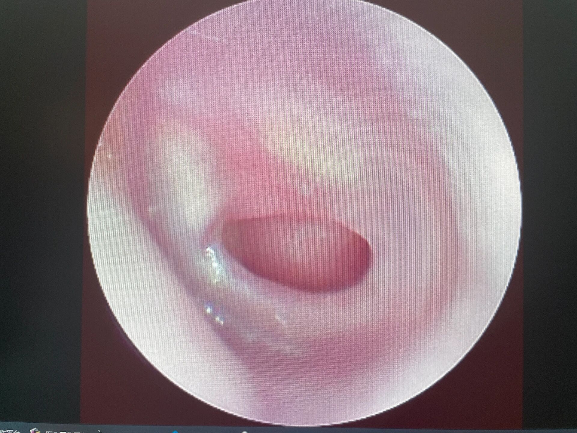 耳膜修复手术图片