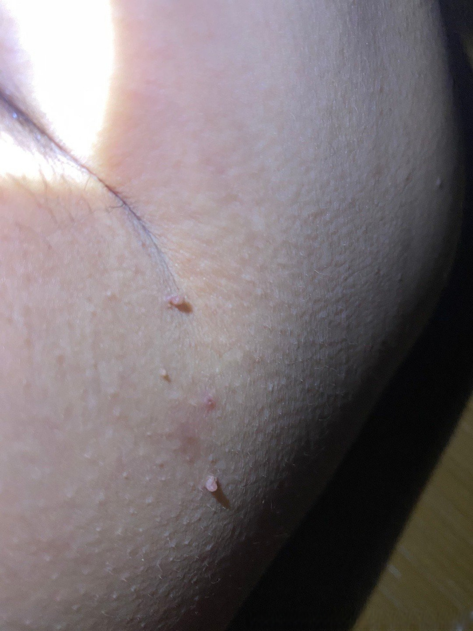 男,33岁,腋下的肉赘发现有两年多了,两侧都有,最近一个月发现脖子也有