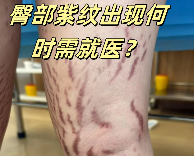 大腿紫纹≠妊娠纹,常见为"生长纹"(膨胀纹),因骨骼肌肉猛长,激素升高