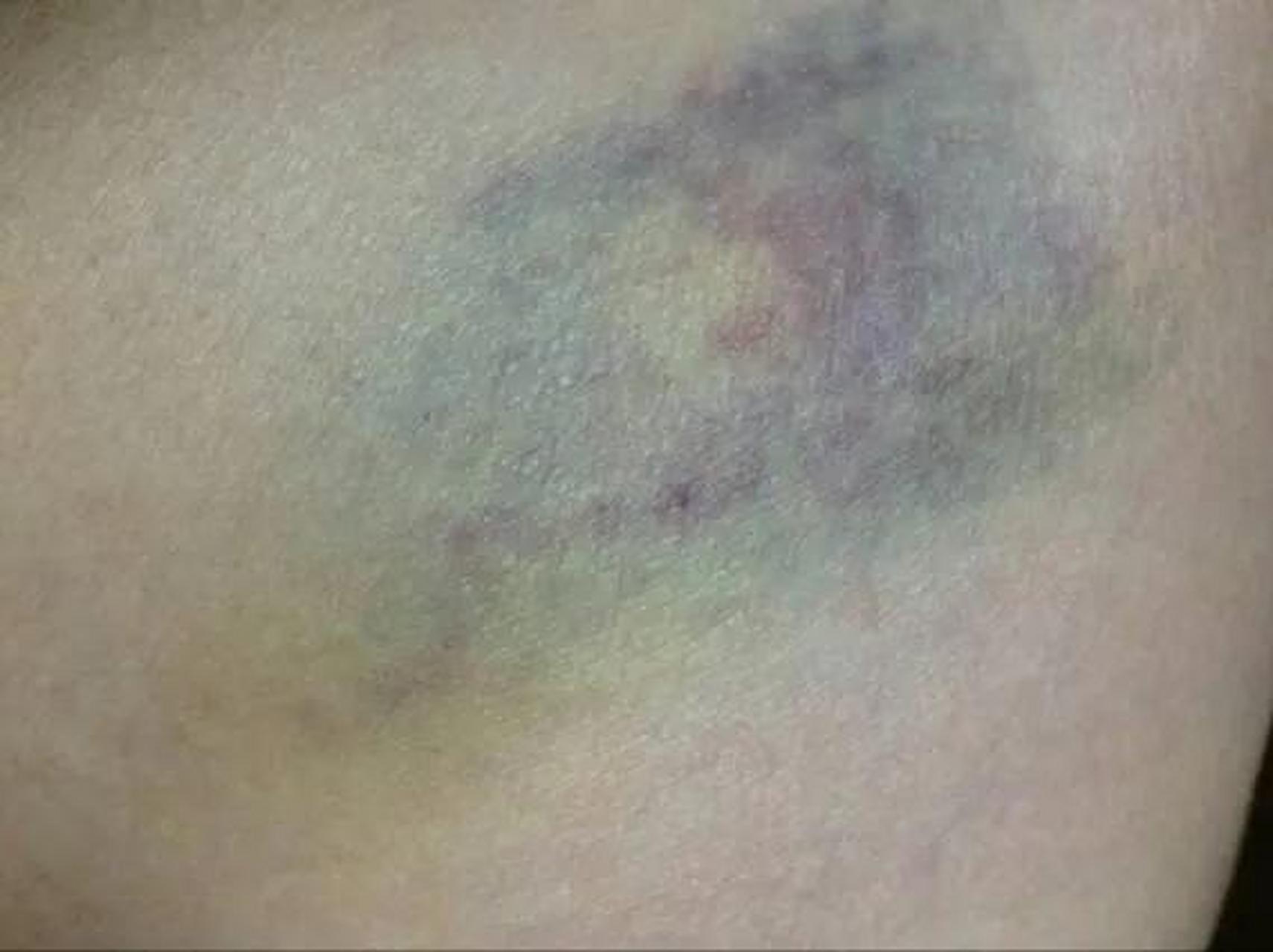 一碰就淤青是怎么回事?