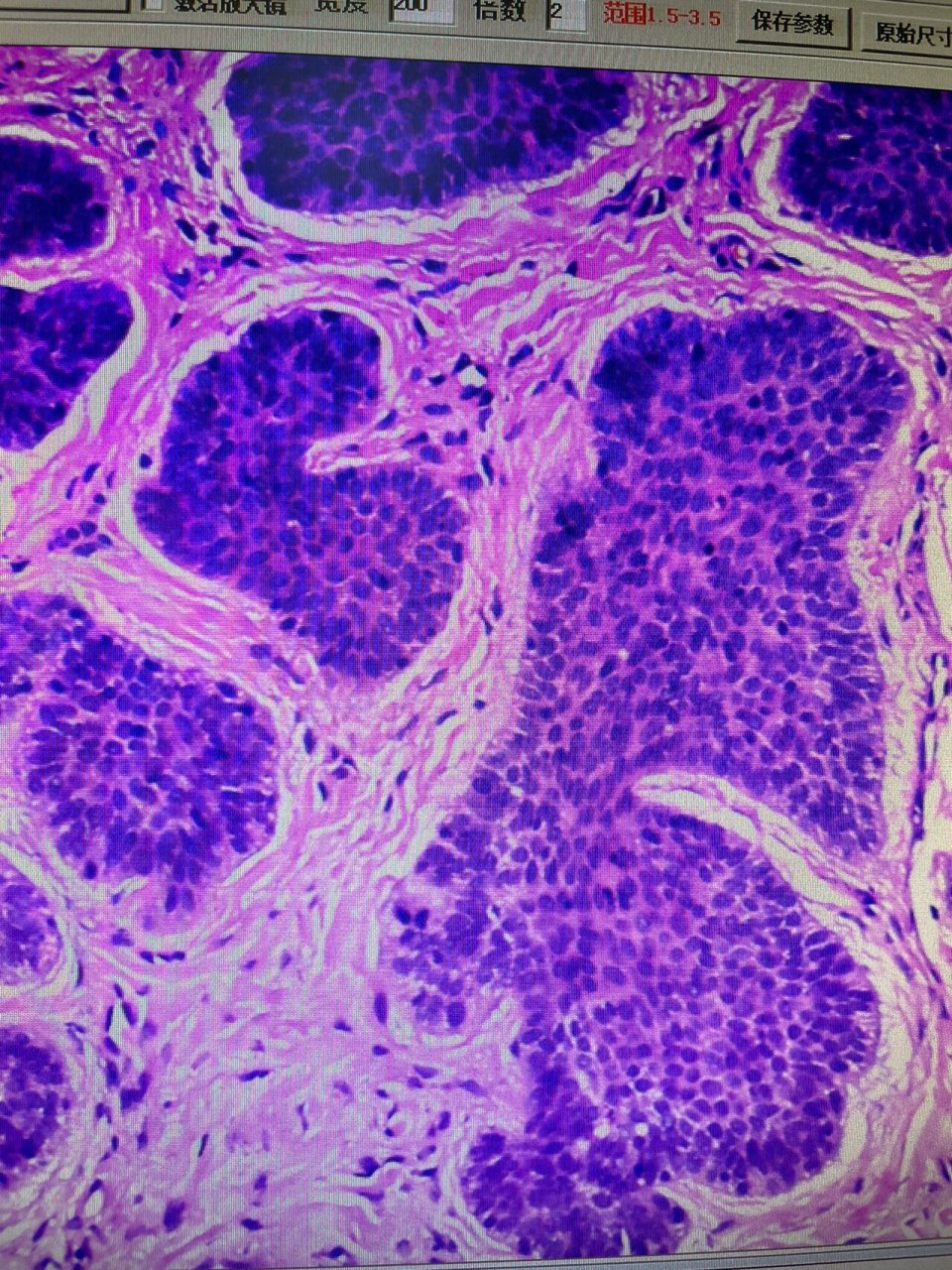 图一 基底细胞癌 图二 毛母细胞瘤