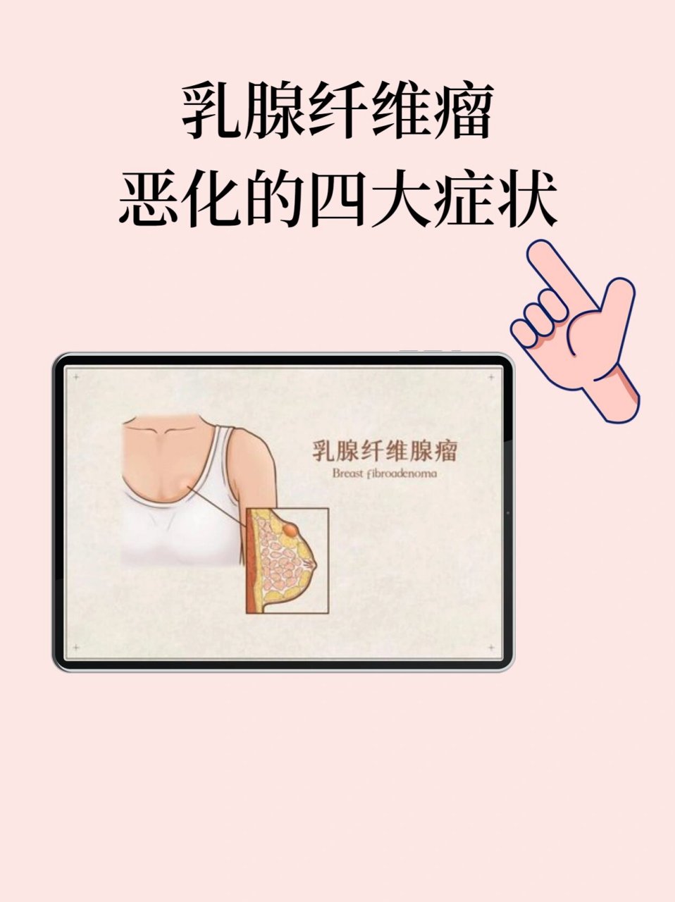 乳腺多发性纤维瘤图片