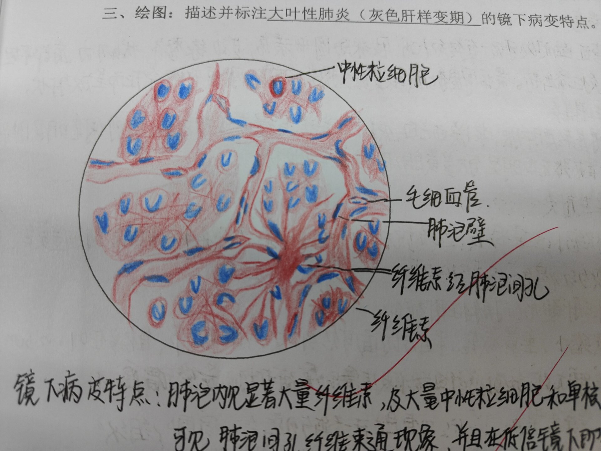 大叶性肺炎病理图图片