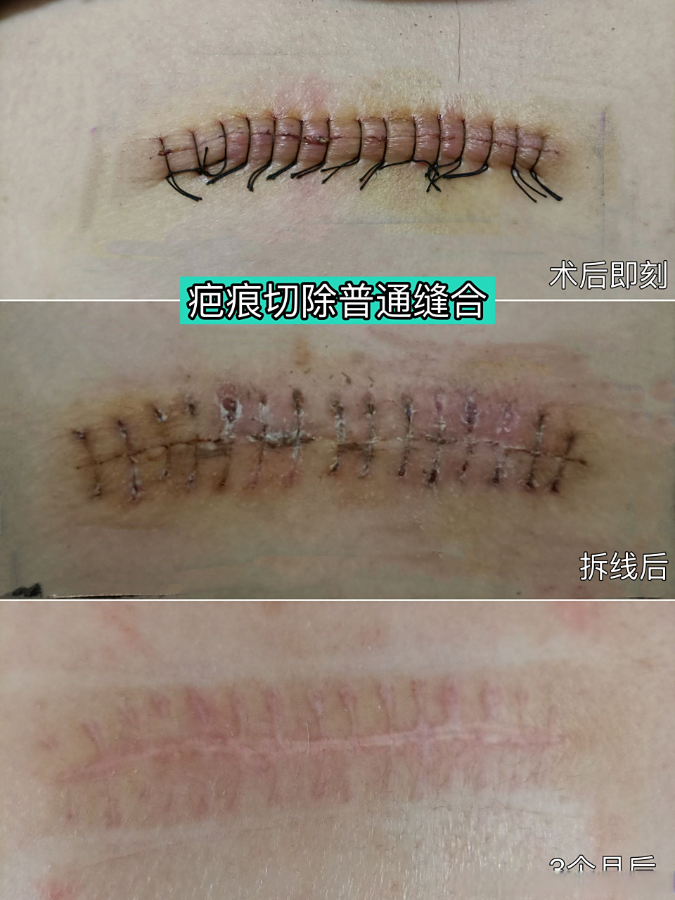 论美容减张缝合的重要性6015 同样是疤痕切除术,不同的缝合方式