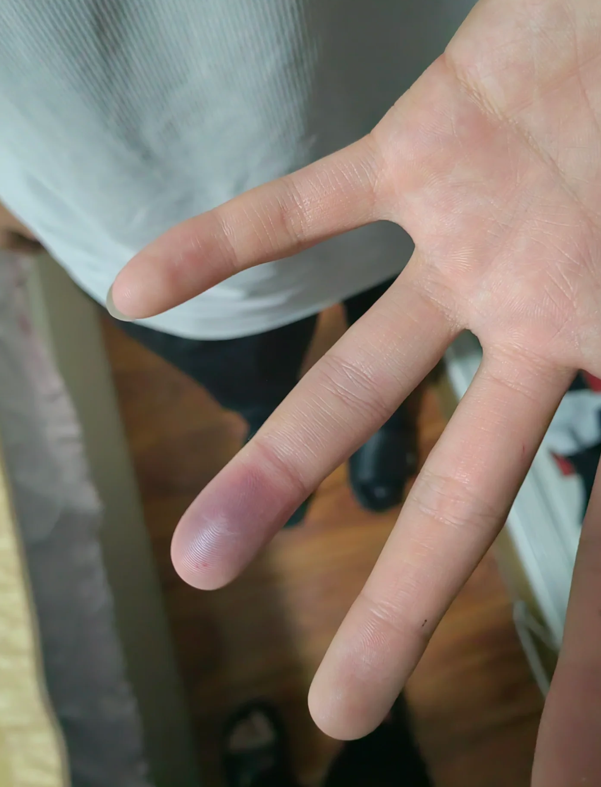 手指被砸肿后,可以这样处理来消肿止痛: