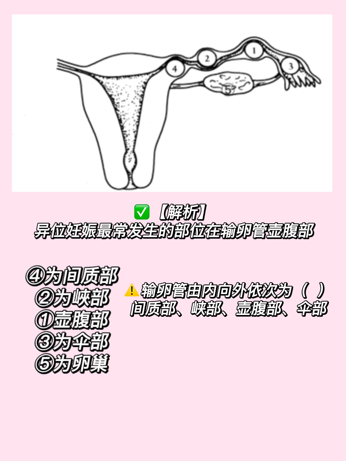 异位妊娠好发部位图片图片