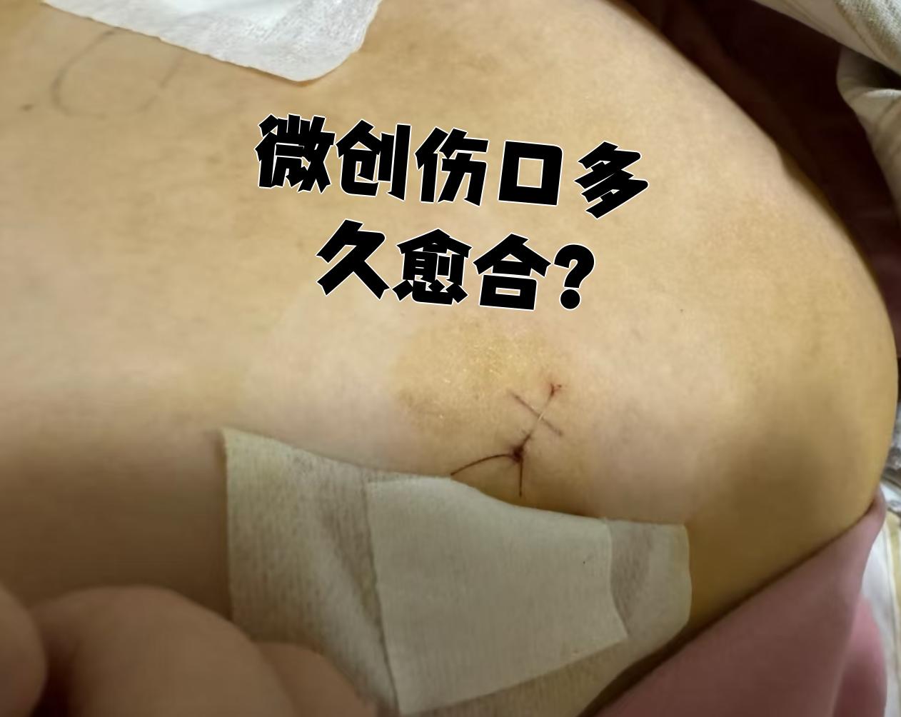 微创手术的伤口一般7到14天就能愈合