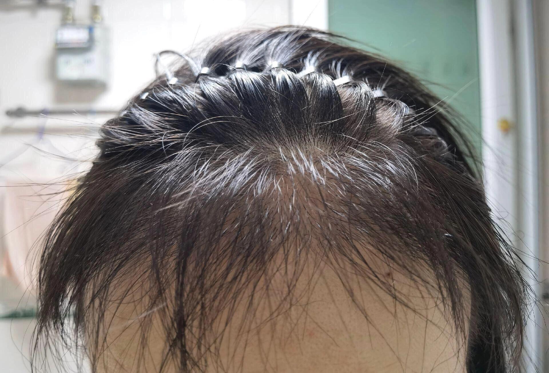 女士植发剃发(女士植发效果图)