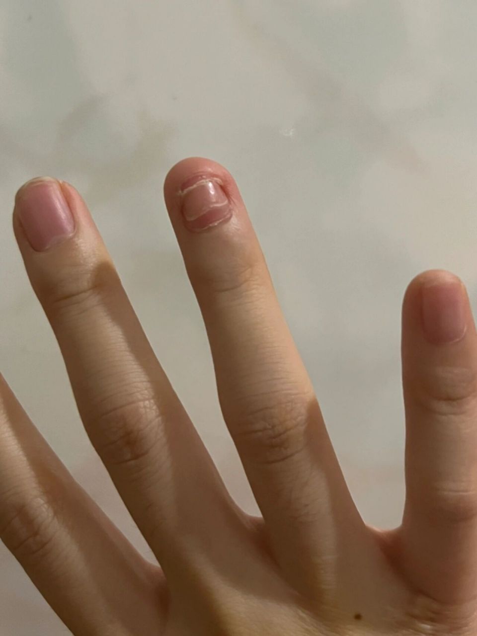 指甲翻掉后长出的新指甲 我现在这个新指甲长出来下面有个棱是因为就