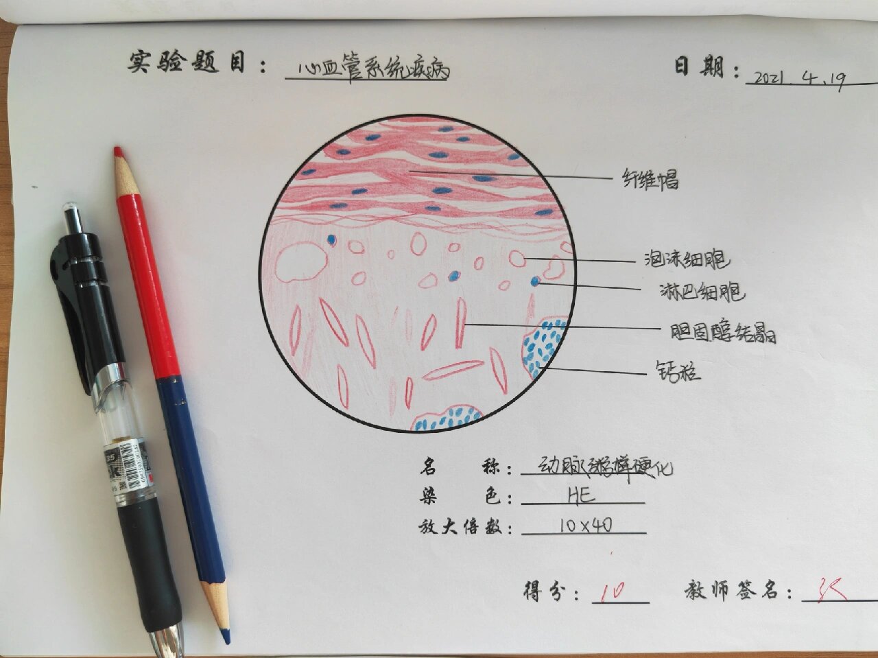 动脉粥样硬化红蓝铅笔图片