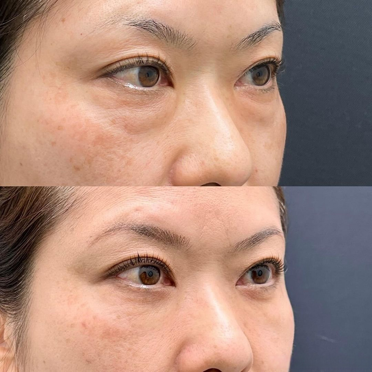 46岁,做完外切祛眼袋半年  因为眼袋明显和松弛,做外切适合她,做完后