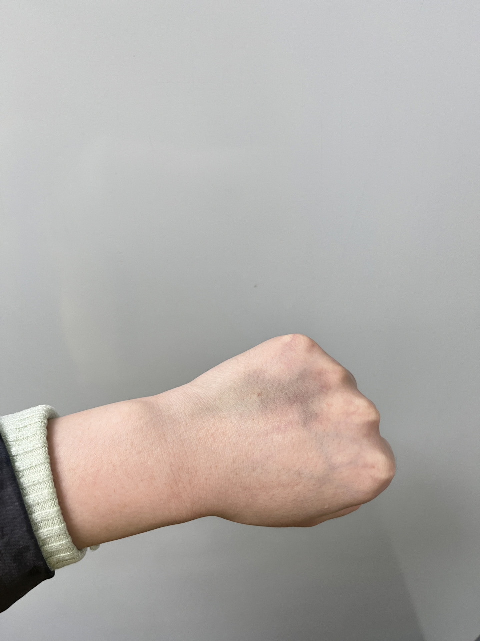 吊水后手总是淤青一块是啥原因啊 19号晚上吊的左手,20号晚上吊的右手