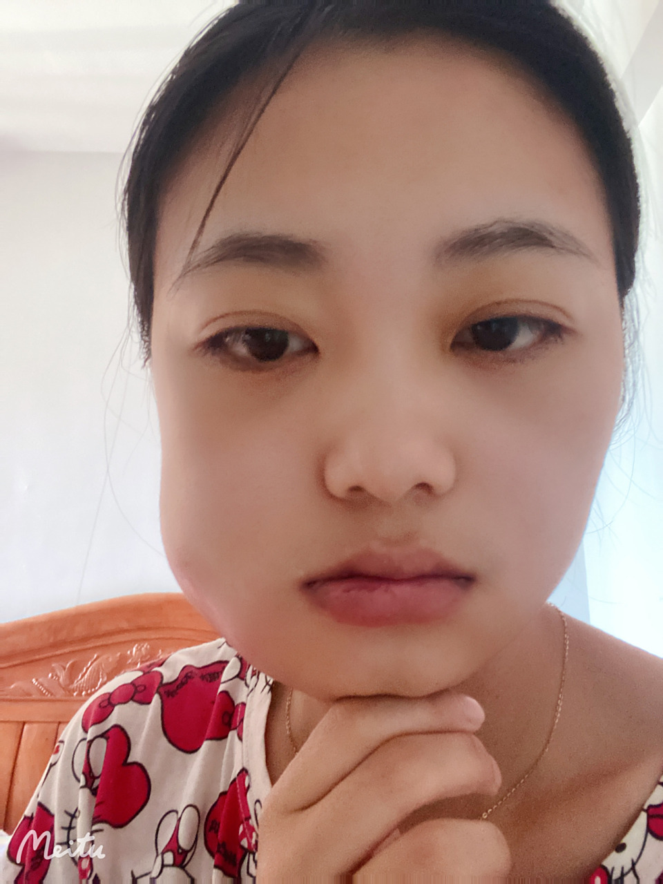 拔智齿第二天肿成了猪头,感觉脸都要挣破的那种,吃了消炎药,冰敷但也