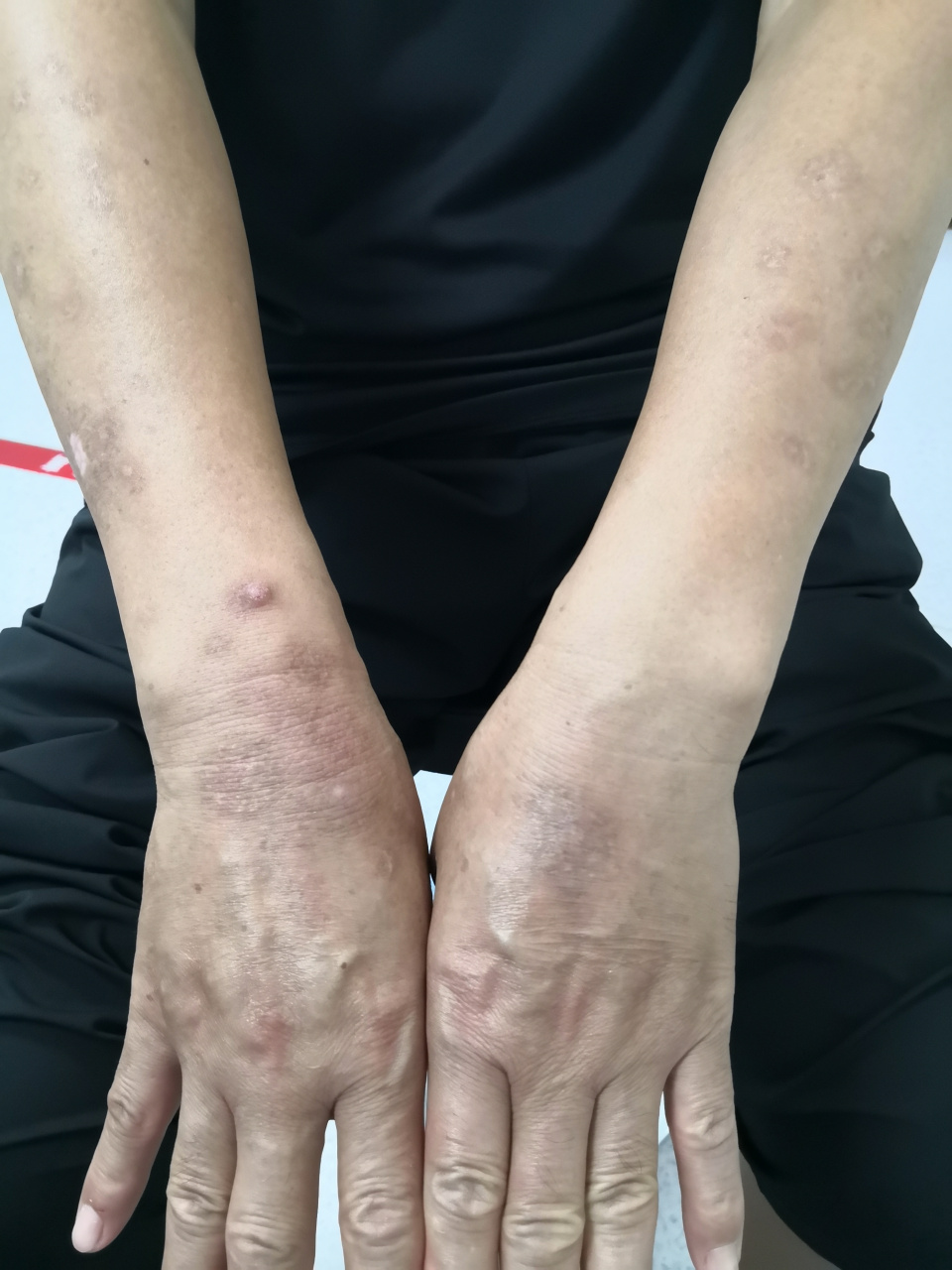 解决皮肤问题专注皮肤美容##特应性皮炎